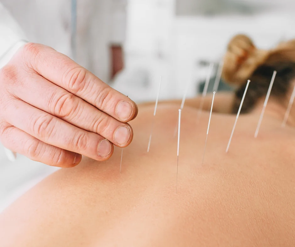 Acupuncture treatment
